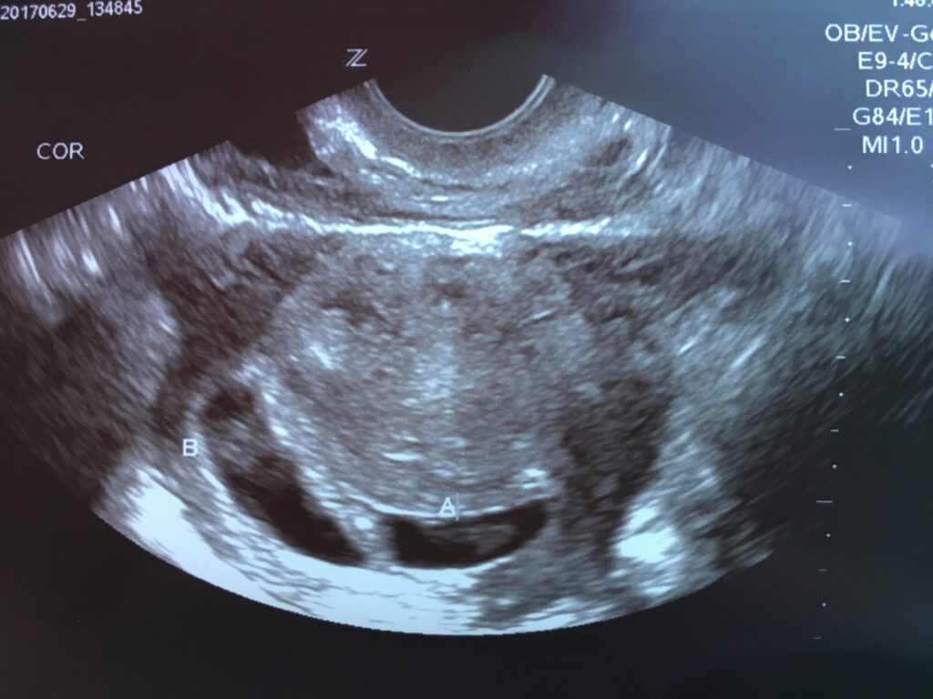 Ultrasound of twin babies